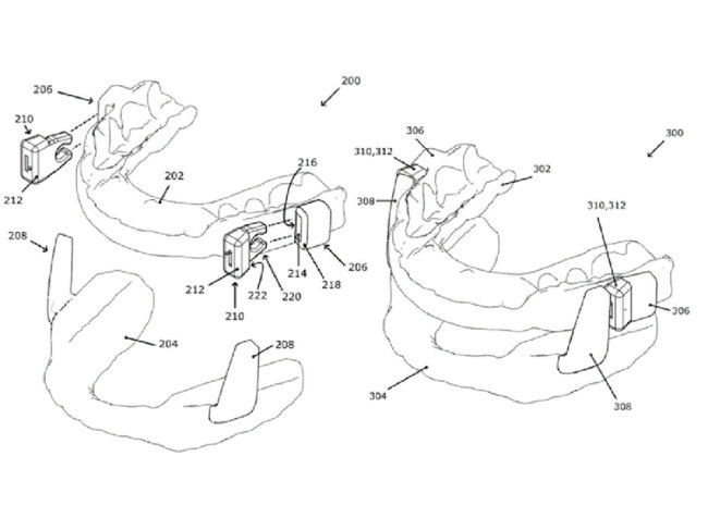 dental splint sleep apnea therapy